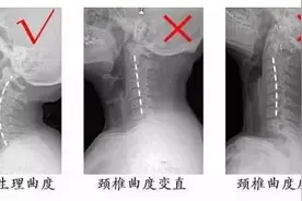 广州白领坐过山车扭了脖子！专家：颈椎病人群慎玩，严重可致瘫图片