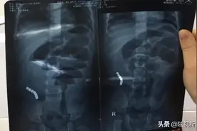 渭南一岁女童误食这种玩具造成多处肠穿孔！警惕！这种玩具可能你家也有图片