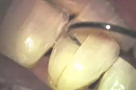 根管治疗后为什么要做牙冠吗？图片