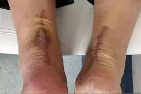 出现长期伤口不愈合的问题？这个新技术就可以解决图片