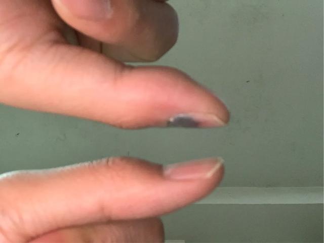 指甲盖被砸了有瘀血怎么办