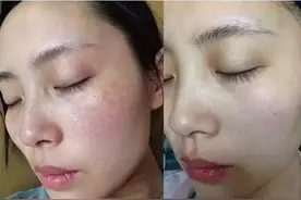激光祛斑会反弹吗？图片