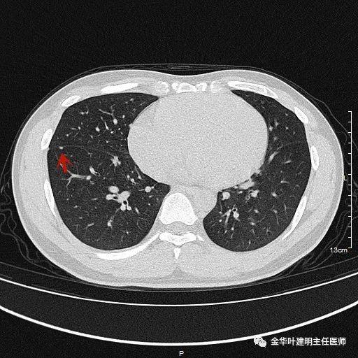 叶建明谈结节：检查发现肺实性结节怎么办？个人版实用指南
