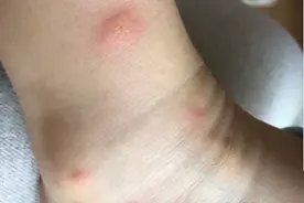 孩子被蚊子叮咬后奇痒无比！这2个实用方法消肿止痒，赶快收藏吧图片