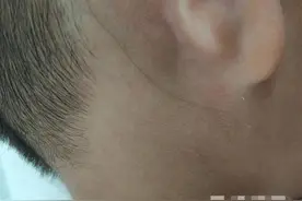 毛发在皮下“游走” 徐州4岁男孩患上罕见病图片