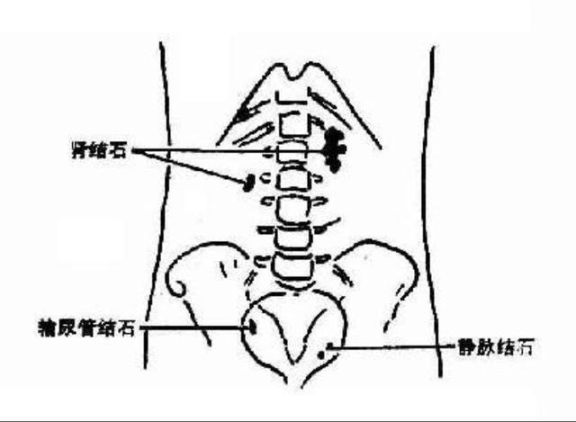 静脉输氨基酸需警惕啦！报告称有草酸钙沉淀，易患肾结石！