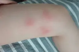 手臂小腿起红色小包，可能是丘疹性荨麻疹图片