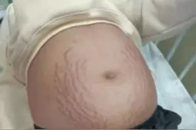 13岁女孩，肚子上全是妊娠纹？放心，这次不是怀孕，但也很危险图片
