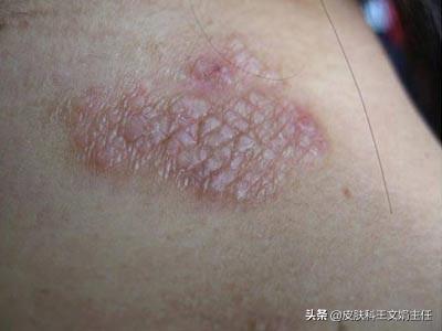 神经性皮炎皮肤异常角化