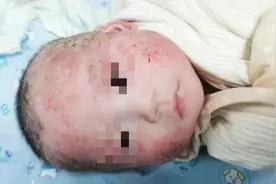 宝宝湿疹结痂比硬币还厚，妈妈绝望地说：“我记不清他长啥样了”图片