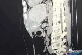 注意！被鱼刺卡喉时别冒险处理，很多人都做错了，结果只能手术取出图片