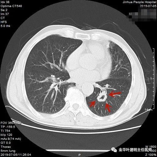 叶建明谈结节：检查发现肺实性结节怎么办？个人版实用指南
