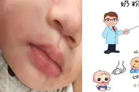 宝宝奶粉过敏了！怎么破？图片