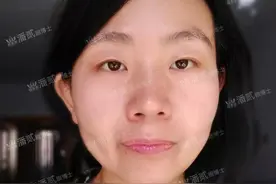 上睑下垂矫正： 想要眼大有神，通过提肌手术来实现吧图片