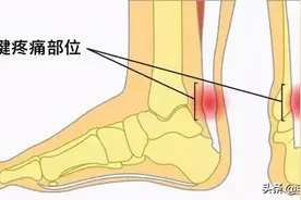 中老年女性常患有腱鞘炎，应该怎么办？医生告诉您详细的治疗方法图片