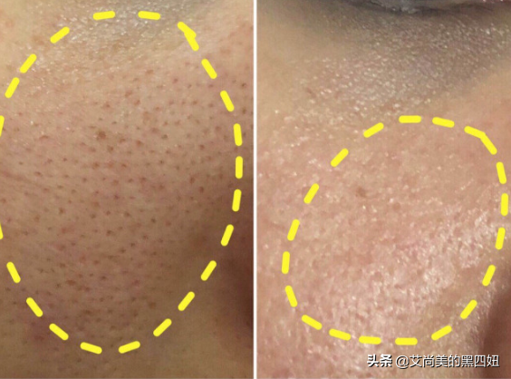 可以去除鸡皮肤的方法