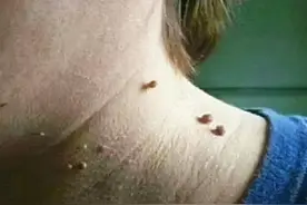 脖子和腋下的“小肉粒”是什么？可以用手拉吗？会不会影响健康？图片