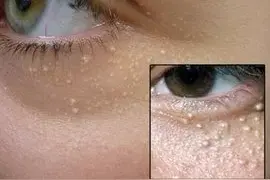 眼睛周围长了脂肪粒怎么办？教你一招，不用针挑也不用手抠图片