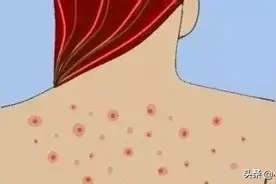 后背老长痘，是因为没洗干净？可能你忽略了这一点图片