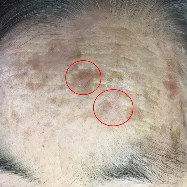 如何治疗日光性角化皮肤病