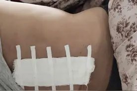 腰椎取钢钉手术亲身体验图片