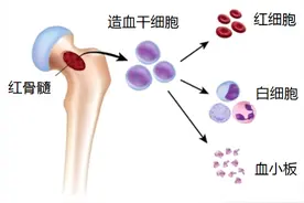 体检发现脾脏肿大，警惕“中招”骨髓纤维化图片