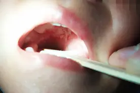 【呱呱教25】高发季！开学后儿童口内长小疱疱?这是疱疹性咽峡炎图片