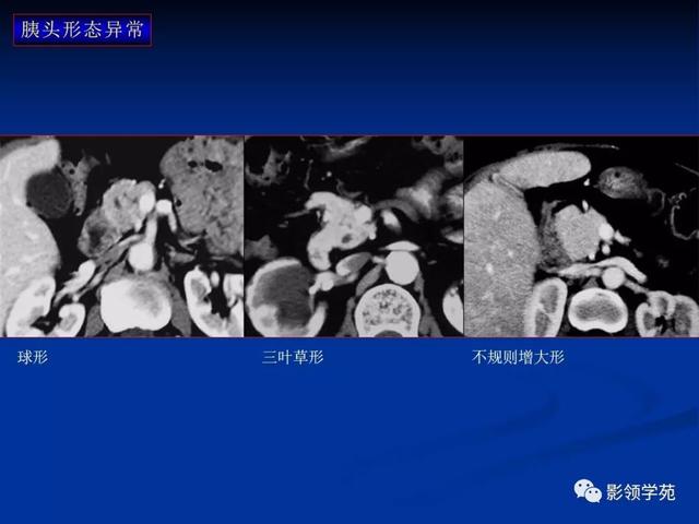 胰腺的解剖与常见变异