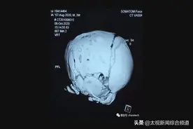 太原：宝宝畸形修复，医生借3D打印做手术图片