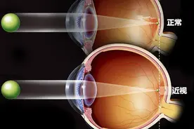 你了解什么是眼轴吗？图片