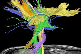 神经磁共振（MRI）系列之丘脑病变-精品图集图片