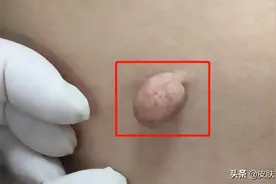 皮肤上长小肉球，能不能用头发系掉？图片