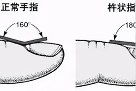 手上有这三个“标记”就说明你的肺不好！附养肺“三字经”图片