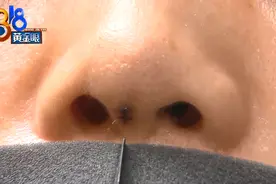 做完手术三年后，鼻头下面假体露了出来图片