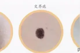 “科技之春”之三院讲堂 | 谈谈色素痣的那些事儿图片