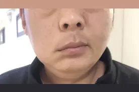 眼皮老跳动，可能是面肌痉挛缠身图片