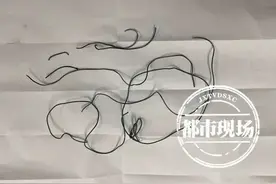 10岁男孩体内发现1.5米长电线，竟是他自己插进去的图片
