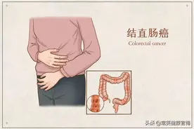 结直肠癌是可防可治的“懒癌”，掌握这几步最关键图片