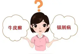 不要迷信小广告，带你正确了解“牛皮癣”—银屑病图片