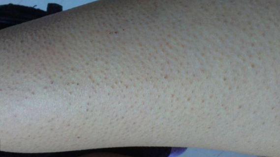 大鸡皮疙瘩皮肤病