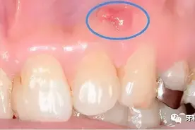 牙龈上长脓包，敢不敢自己戳破？图片