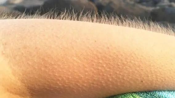 身上起一块一块的鸡皮疙瘩一样的是什么原因