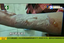 三年前网购水壶 如今手柄断裂 热水烫伤手臂能否成功索赔？图片