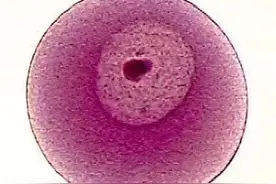 霉菌性阴道炎是什么引起的？能根治吗？图片