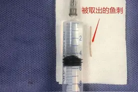 太尴尬了！女子“痔疮”疼痛难忍，一查是这个卡在肛门了图片