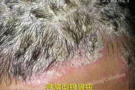 一代“神药”维A酸会不会跌下神坛？图片