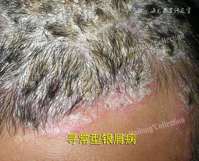 艾滋会引起毛囊角化症