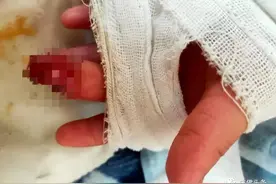 细思极恐！4岁女童玩这个睡着，差点截肢……图片