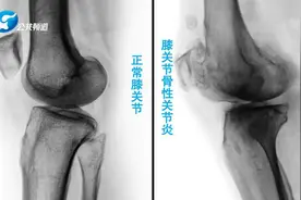 膝关节积液能不能抽？会不会越抽越多？恢复期如何锻炼？专业医生来支招原创图片
