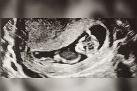 爱的胎记！双胞胎姐姐“消失”在腹中，化为胎记印在弟弟腿上图片